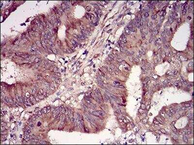 Immunohistochemistry: Casein Kinase 2 beta Antibody (2F12F3) [NBP2-52449] - Analysis of paraffin-embedded colon cancer tissues using CSNK2B mouse mAb with DAB staining.