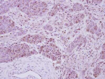 Immunohistochemistry-Paraffin: Casein Kinase 2 beta Antibody [NBP2-21570] - Immunohistochemical analysis of paraffin-embedded Breast ca, using antibody at 1:250 dilution.