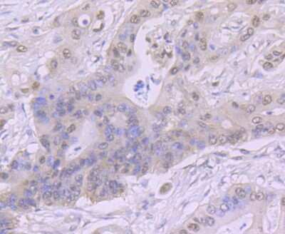 Immunohistochemistry-Paraffin: Casein Kinase 2 beta Antibody (JU37-62) [NBP2-75431] - Analysis of paraffin-embedded human colon cancer tissue using anti-CSNK2B antibody. Counter stained with hematoxylin.