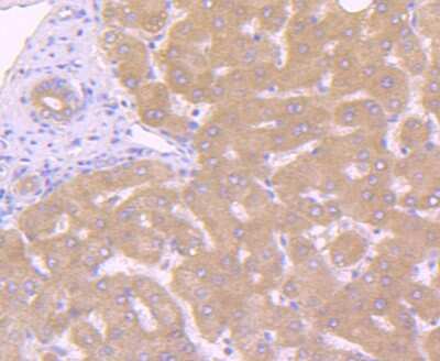 Immunohistochemistry-Paraffin: Caspase-10/FLICE2 Antibody (JJ0890) [NBP2-67878] - Analysis of paraffin-embedded human liver cancer tissue using anti-Caspase-10 antibody. Counter stained with hematoxylin.
