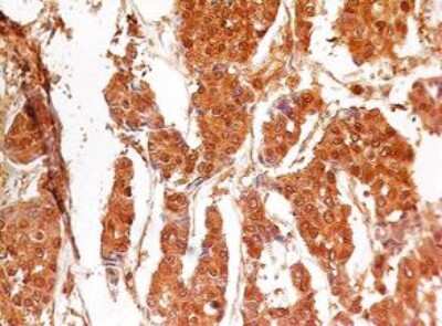 Analysis in human breast cancer stained at 4ug/ml. Localization can be cytoplasmic and nuclear. Staining in the nucleus is considered to be an indication of active Caspase-3. In most cell types and model systems, cells with active Caspase-3 are undergoing apoptosis.