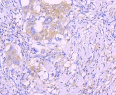 Immunohistochemistry-Paraffin: Caspase-8 Antibody (SD08-06) - Pro form [NBP2-67803] - Analysis of paraffin-embedded human lung cancer tissue using anti-Caspase-8 antibody. Counter stained with hematoxylin.