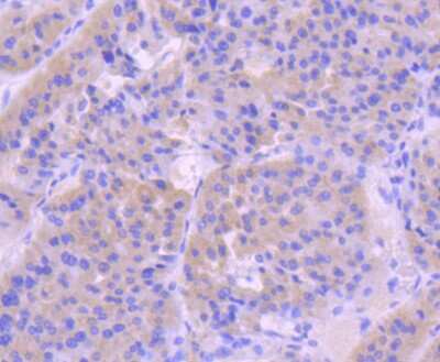 Immunohistochemistry-Paraffin: Caspase-9 Antibody (JJ08-05) - Pro form [NBP2-67848] - Analysis of paraffin-embedded human liver cancer tissue using anti-pro Caspase 9 antibody. Counter stained with hematoxylin.