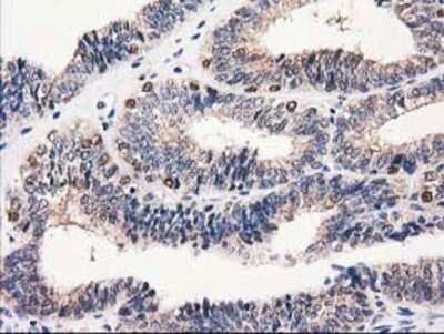 Immunohistochemistry: Catalase Antibody (OTI1B8) - Azide and BSA Free [NBP2-70342] - Staining of paraffin-embedded Adenocarcinoma of Human endometrium tissue using anti-Catalase mouse monoclonal antibody.