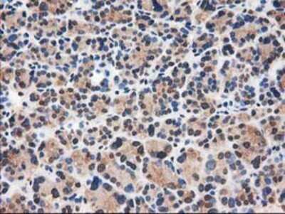 Immunohistochemistry: Catalase Antibody (OTI1B8) - Azide and BSA Free [NBP2-70342] - Staining of paraffin-embedded Carcinoma of Human thyroid tissue using anti-Catalase mouse monoclonal antibody.