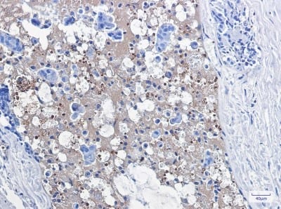 Immunohistochemistry-Paraffin: Catalase Antibody (S01-8B2) [NBP3-19593] - Immunohistochemistry of Catalase in paraffin-embedded Human breast cancer tissue using NBP3-19593 at dilution 1/100