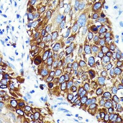 Immunohistochemistry-Paraffin: Cathepsin B Antibody (6I5D7) [NBP3-15614] - Immunohistochemistry of paraffin-embedded human lung cancer using Cathepsin B Rabbit mAb (NBP3-15614) at dilution of 1:100 (40x lens).Perform microwave antigen retrieval with 10 mM PBS buffer pH 7.2 before commencing with IHC staining protocol.