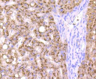Immunohistochemistry-Paraffin: Cathepsin B Antibody (JA11-02) [NBP2-67215] - Analysis of paraffin-embedded human liver cancer tissue using anti-Cathepsin B antibody. Counter stained with hematoxylin.