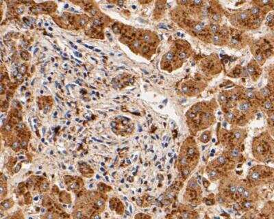 Immunohistochemistry-Paraffin: Cathepsin D Antibody (13F2) [NBP2-89156] - Analysis of paraffin-embedded human lung tissue using anti-Cathepsin D antibody. The section was pre-treated using heat mediated antigen retrieval with Tris-EDTA buffer (pH 8.0-8.4) for 20 minutes.The tissues were blocked in 5% BSA for 30 minutes at room temperature, washed with ddH2O and PBS, and then probed with the primary antibody( 1/50) for 30 minutes at room temperature. The detection was performed using an HRP conjugated compact polymer system. DAB was used as the chromogen. Tissues were counterstained with hematoxylin and mounted with DPX.