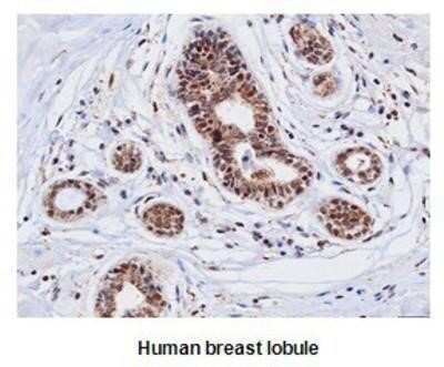 Immunohistochemistry-Paraffin: Cathepsin D Antibody (4G2) [NBP1-04278] - human Cathepsin D (1:50) for 2 hours at room temperature. Antigen retrieval was performed in 0.1M sodium citrate buffer and detected using Diaminobenzidine (DAB)