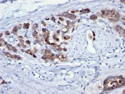 Immunohistochemistry-Paraffin: Cdc20 Antibody (AR12) - Azide and BSA Free [NBP2-34552] - Formalin-fixed, paraffin-embedded human Gastric Carcinoma stained with Cdc20 Antibody (AR12).