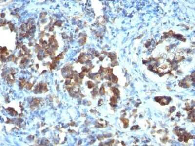 Immunohistochemistry-Paraffin: Cdc20 Antibody (CDC20/1102) - Azide and BSA Free [NBP2-47811] - Human Gastric Carcinoma stained with CDC20 Monoclonal Antibody (CDC20/1102)