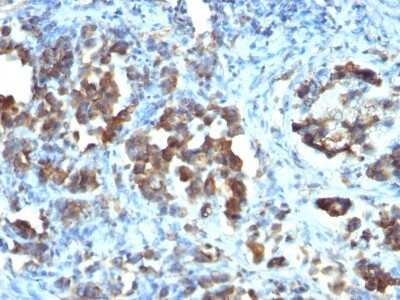 Immunohistochemistry-Paraffin: Cdc20 Antibody (CDC20/1102) [NBP2-44407] - Human Gastric Carcinoma stained with CDC20 Monoclonal Antibody (CDC20/1102)