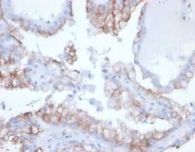 Immunohistochemistry-Paraffin: Cdc20 Antibody (rCDC20/7184) [NBP3-13819] - Formalin-fixed, paraffin-embedded human kidney cancer stained with Cdc20 antibody (rCDC20/7184) at 2ug/ml. HIER: Tris/EDTA, pH9.0, 45min. HRP-polymer, 30min. DAB, 5min.