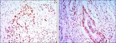 Immunohistochemistry-Paraffin: Cdc27 Antibody (5C12) [NBP1-51620] - Immunohistochemical analysis of paraffin-embedded lung cancer tissues (left) and colon cancer tissues (right) using CDC27 mouse mAb with DAB staining.