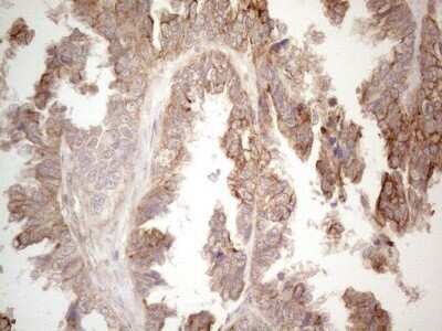 Immunohistochemistry: Cdc6 Antibody (OTI1A4) - Azide and BSA Free [NBP2-70383] - Analysis of Adenocarcinoma of Human ovary tissue. (Heat-induced epitope retrieval by 1mM EDTA in 10mM Tris buffer (pH8.5) at 120C for 3 min)
