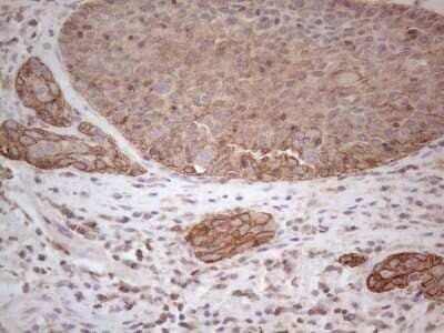 Immunohistochemistry: Cdc6 Antibody (OTI1A4) - Azide and BSA Free [NBP2-70383] - Analysis of Carcinoma of Human bladder tissue. (Heat-induced epitope retrieval by 1mM EDTA in 10mM Tris buffer (pH8.5) at 120C for 3 min)