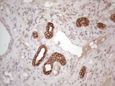 Immunohistochemistry: Cdc6 Antibody (OTI1A4) - Azide and BSA Free [NBP2-70383] - Analysis of Carcinoma of Human liver tissue.(Heat-induced epitope retrieval by 1mM EDTA in 10mM Tris buffer (pH8.5) at 120C for 3 min)