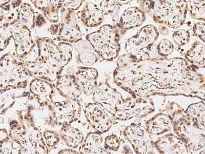 Immunohistochemistry-Paraffin: Cdk6 Antibody [NBP2-98990] - Immunochemical staining of human Cdk6 in human colon carcinoma with rabbit polyclonal antibody at 1:500 dilution, formalin-fixed paraffin embedded sections.