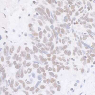 Immunohistochemistry: Cdk7 Antibody (BL-80-5D4) [NBP2-76409] - Detection of human CDK7 in FFPE human ovarian carcinoma by IHC. Antibody: Rabbit anti-CDK7 recombinant monoclonal [BL-80-5D4] (NBP2-76409). Secondary: HRP-conjugated goat anti-rabbit IgG. Substrate: DAB.