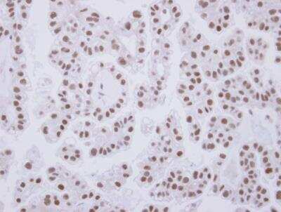 Immunohistochemistry-Paraffin: Cdk7 Antibody [NBP2-15847] - Analysis of paraffin-embedded OVCA, using antibody at 1:250 dilution.