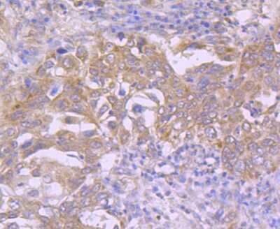 Immunohistochemistry-Paraffin: Cdk7 Antibody (JJ203-01) [NBP2-67850] - Analysis of paraffin-embedded human lung cancer tissue using anti-Cdk7 antibody. Counter stained with hematoxylin.