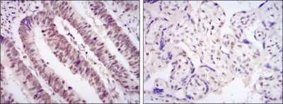 Immunohistochemistry: Cdk9 Antibody (1B5A7) [NBP2-37601] - Immunohistochemical analysis of paraffin-embedded rectum cancer tissues (left) and placenta tissues (right) using CDK9 mouse mAb with DAB staining.