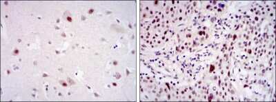 Immunohistochemistry: Cdk9 Antibody (1B5A7) [NBP2-37601] - Immunohistochemical analysis of paraffin-embedded brain tissues (left) and esophageal cancer tissues (right) using CDK9 mouse mAb with DAB staining.