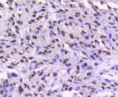 Immunohistochemistry-Paraffin: Cdk9 Antibody (SD204-07) [NBP2-67811] - Analysis of paraffin-embedded human breast carcinoma tissue using anti-Cdk9 antibody. Counter stained with hematoxylin.