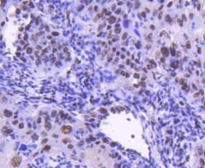 Immunohistochemistry-Paraffin: Cdk9 Antibody (SD204-07) [NBP2-67811] - Analysis of paraffin-embedded human lung cancer tissue using anti-Cdk9 antibody. Counter stained with hematoxylin.