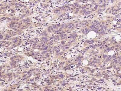 Immunohistochemistry-Paraffin: Centrin 1 Antibody [NBP2-99465] - Immunochemical staining of human Centrin 1 in human pancreatic carcinoma with rabbit polyclonal antibody at 1:500 dilution, formalin-fixed paraffin embedded sections.