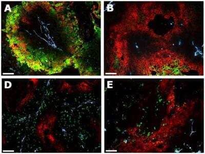 Immunohistochemistry: Chemotherapy Insensitive Tumor Cells Antibody Pack [NBP1-78942] - Images showing Carbonic Anhydrase IX/CA9 expression, pimonidazole, apoptosis and proliferation in SCCNij202.Carbonic Anhydrase IX/CA9 is expressed in hypoxic regions as assessed by pimonidazole staining (A), but is also observed in non-pimonidazole areas (B). Yet, most of Carbonic Anhydrase IX/CA9 is expressed in pimonidazole positive regions (C). Green, pimonidazole (A-B), BrdUrd (D) or caspase-3 (E); Yellow, overlap of Carbonic Anhydrase IX/CA9 (red) and pimonidazole (green); Light blue, vessels. Scale bars represent 100 um. Closed circles represent Carbonic Anhydrase IX/CA9 expression in pimonidazole positive regions; open circles represent Carbonic Anhydrase IX/CA9 expression in pimonidazole negative regions. Image collected and cropped by CiteAb from the following publication (//dx.plos.org/10.1371/journal.pone.0108068), licensed under a CC-BY license. Anti-CA9 Antibody (NB100-417)
