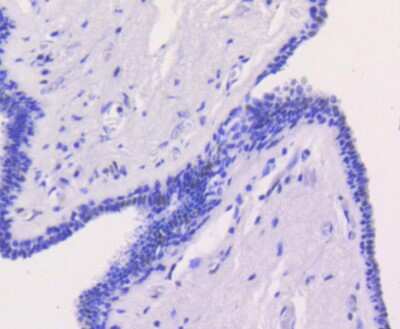 Immunohistochemistry-Paraffin: Chk2 Antibody (SC604) [NBP2-67595] - Analysis of paraffin-embedded human breast carcinoma tissue using anti-Chk2 antibody. Counter stained with hematoxylin.