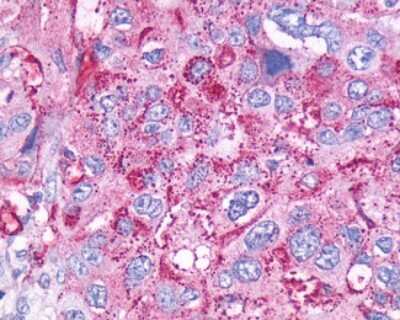 Immunohistochemistry-Paraffin: Cholecystokinin-B R/CCKBR Antibody [NLS1282] - Analysis of anti-CCKBR / Cckb antibody with human pancreas, carcinoma.