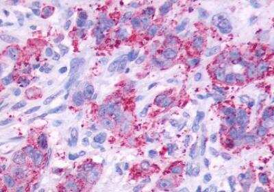 Immunohistochemistry-Paraffin: Cholecystokinin-B R/CCKBR Antibody [NLS1282] - Human Stomach, Adenocarcinoma. Immunohistochemistry of formalin-fixed, paraffin-embedded tissue after heat-induced antigen retrieval.