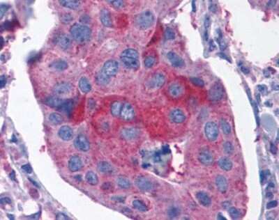 Immunohistochemistry-Paraffin: Cholecystokinin-B R/CCKBR Antibody [NLS6535] - Analysis of anti-CCKBR / Cckb antibody with human breast, carcinoma.