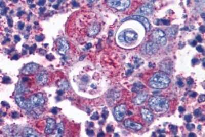 Immunohistochemistry-Paraffin: Cholecystokinin-B R/CCKBR Antibody [NLS6535] - Anti-CCKBR / Cckb antibody IHC of human Colon, Carcinoma. Immunohistochemistry of formalin-fixed, paraffin-embedded tissue after heat-induced antigen retrieval.