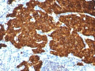 Immunohistochemistry-Paraffin: Chromogranin A Antibody (CGA/413 + CHGA/777 + CHGA/798) - Azide and BSA Free [NBP2-47846] - Pheochromocytoma stained with Chromogranin A Monoclonal Antibody (CGA/413+ CHGA/777+ CHGA/798)