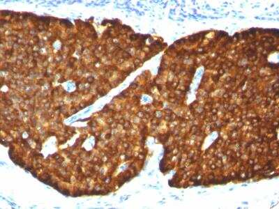 Immunohistochemistry-Paraffin: Chromogranin A Antibody (CGA/413) - Azide and BSA Free [NBP2-47850] - Human Pheochromocytoma stained with Chromogranin A Monoclonal Antibody (CGA/413)