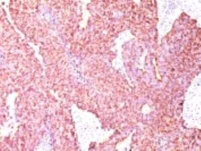 Immunohistochemistry-Paraffin: Chromogranin A Antibody (CGA/414) - Azide and BSA Free [NBP2-33198] - Formalin-fixed, paraffin-embedded human small cell Lung Carcinoma stained with Chromogranin A Monoclonal Antibody (CGA/414)