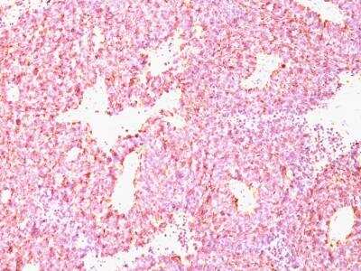 Immunohistochemistry-Paraffin: Chromogranin A Antibody (CHGA/798) - Azide and BSA Free [NBP2-47849] - Human SC Lung Carcinoma stained with Chromogranin A Monoclonal Antibody (CHGA/798)