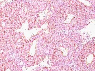 Immunohistochemistry-Paraffin: Chromogranin A Antibody (CHGA/798) - IHC-Prediluted [NBP2-48072] - Human SC Lung Carcinoma stained with Chromogranin A MAb (CHGA/798)