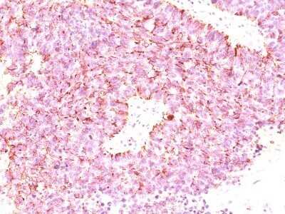 Immunohistochemistry-Paraffin: Chromogranin A Antibody (LK2H10 + PHE5 + CGA/414) - Azide and BSA Free [NBP2-34674] - Formalin-fixed, paraffin-embedded human small cell lung carcinoma stained with Chromogranin A MAb (LK2H10+PHE5+CGA414)