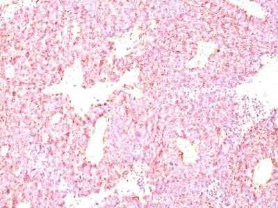 Immunohistochemistry-Paraffin: Chromogranin A Antibody (LK2H10 + PHE5) - Azide and BSA Free [NBP2-34673] - Formalin-fixed, paraffin-embedded human small cell lung carcinoma stained with Chromogranin A MAb (LK2H10+PHE5)