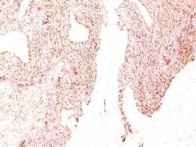 Immunohistochemistry-Paraffin: Chromogranin A Antibody (SPM339) - Azide and BSA Free [NBP2-34764] - Formalin-paraffin small cell lung carcinoma stained with Chromogranin A MAb (SPM339)