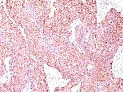 Immunohistochemistry-Paraffin: Chromogranin A Antibody (SPM585) - Azide and BSA Free [NBP2-34815] - Formalin-paraffin small cell lung carcinoma stained with Chromogranin A MAb (SPM585)
