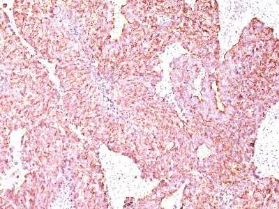 Immunohistochemistry-Paraffin: Chromogranin A Antibody (SPM585) - IHC-Prediluted [NBP2-44770] - Formalin-paraffin small cell lung carcinoma stained with Chromogranin A MAb (SPM585)