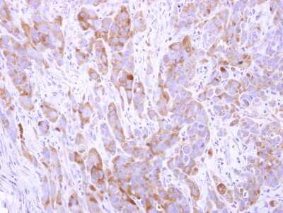 Immunohistochemistry-Paraffin: Cingulin Antibody [NBP2-15904] - Cytoplasm on Ovarian carcinoma; antibody dilution: 1:500.