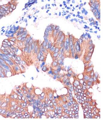 Immunohistochemistry-Paraffin: Cingulin Antibody [NBP2-92240] - Immunohistochemistry of paraffin-embedded Human colon carcinoma using Cingulin Rabbit pAb (NBP2-92240) at dilution of 1:100 (40x lens). Perform microwave antigen retrieval with 10 mM PBS buffer pH 7.2 before commencing with IHC staining protocol.