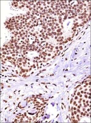 Immunohistochemistry-Paraffin: Cited-2 Antibody (JA22) - Azide and BSA Free [NBP2-80671] - IHC analysis of a formain fixed paraffin embedded (FFPE) tissue section of human breast cancer using Cited-2 antibody at 1:500 dilution. The primary antibody bound to CAIX antigens in the tissue section was detected using a HRP labeled secondary antibody